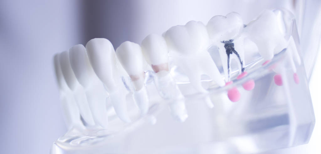 Root Canal Perth: What Is A Root Canal And Why Might You Need One?