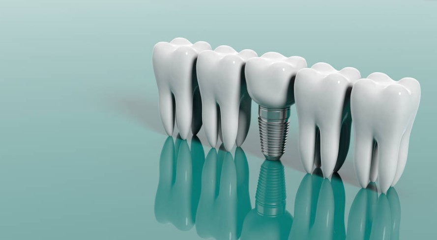 all on 4 dental implants
